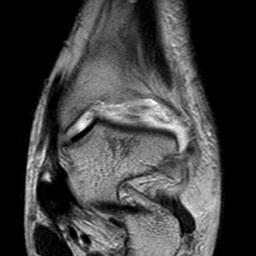 File:Anterior talofibular ligament rupture (Radiopaedia 15831-15484 Coronal T2 7).jpg