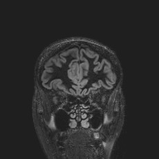 Anterior temporal encephalocele (Radiopaedia 82624-96808 Coronal FLAIR 10).jpg