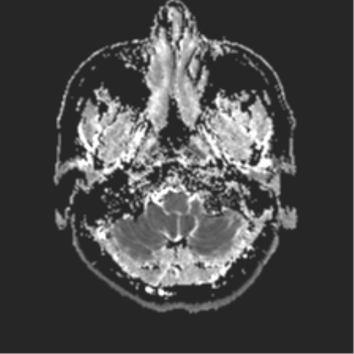 File:Anterior temporal lobe perivascular space (Radiopaedia 40946-43650 Axial ADC 2).png