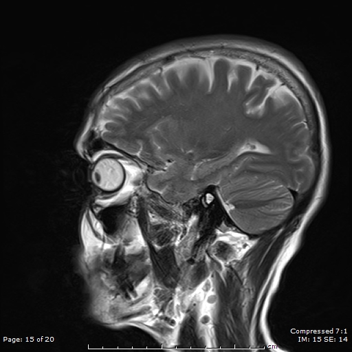 File:Anterior temporal lobe perivascular space (Radiopaedia 88283-104914 Sagittal T2 15).jpg