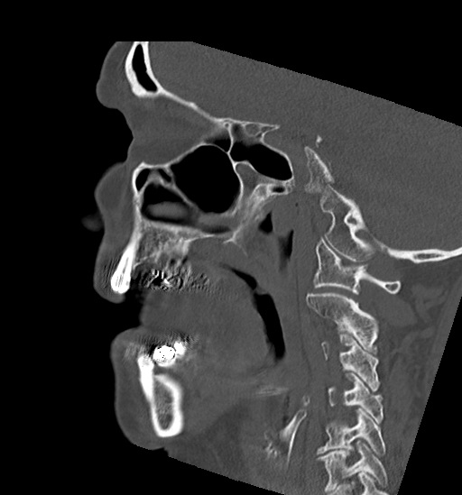 Anterior temporomandibular joint dislocation (Radiopaedia 59430-66784 B 39).jpg
