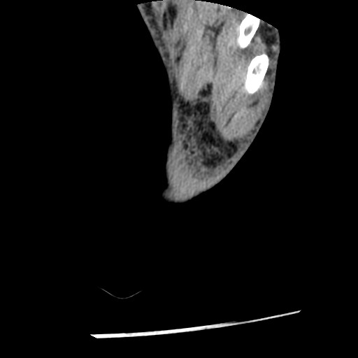 Anterior tibial artery false aneurysm (Radiopaedia 88984-105809 A 259).jpg
