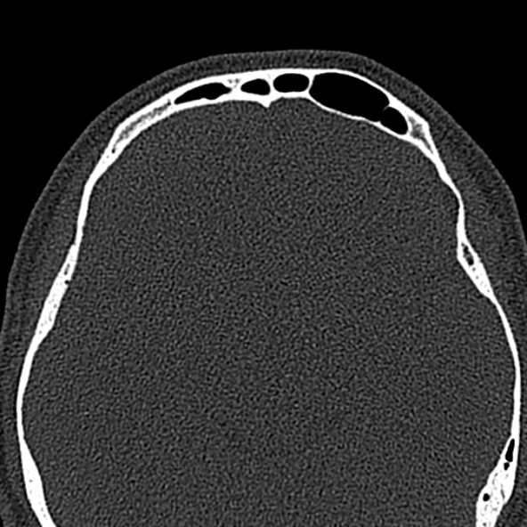 Antrochoanal polyp (Radiopaedia 30002-30554 Axial bone window 55).jpg