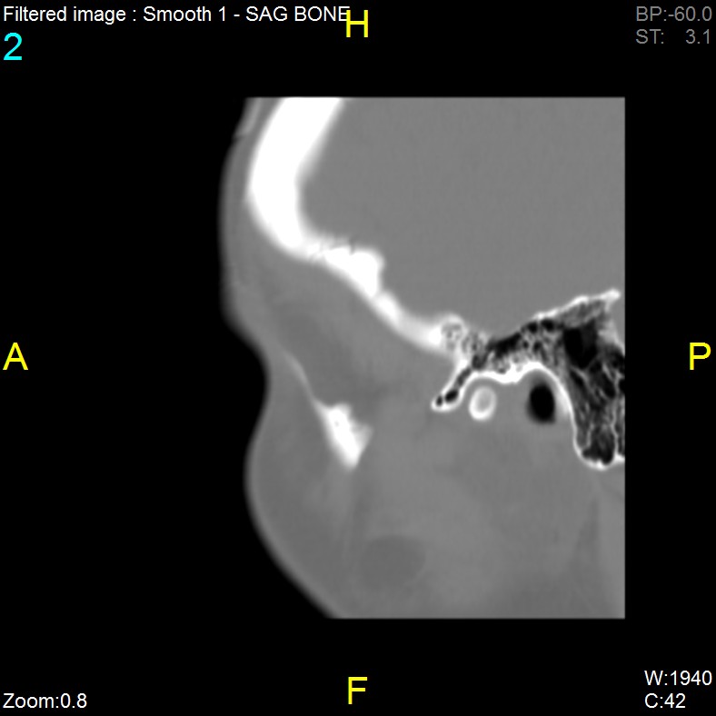 Antrochoanal polyp (Radiopaedia 65101-74094 Sagittal bone window 2).jpg