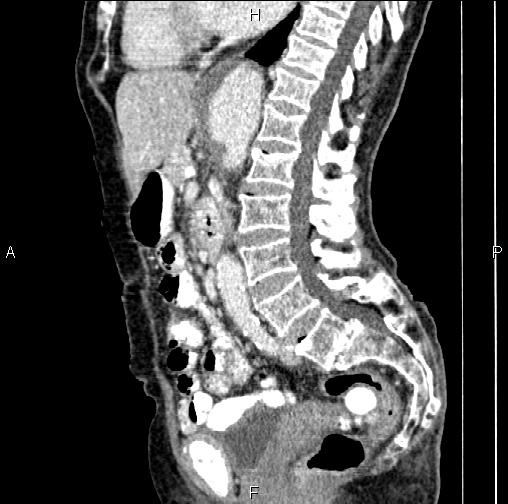 Aortic aneurysm and Lemmel syndrome (Radiopaedia 86499-102554 D 45).jpg