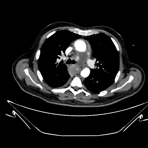 File:Aortic arch aneurysm (Radiopaedia 84109-99365 C 153).jpg