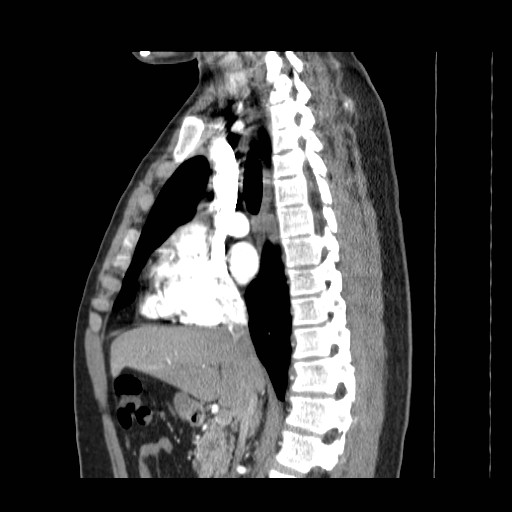 File:Aortic arch stent (Radiopaedia 30030-30595 E 3).jpg