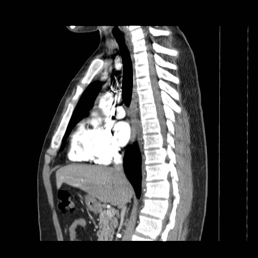 File:Aortic arch stent (Radiopaedia 30030-30595 E 5).jpg