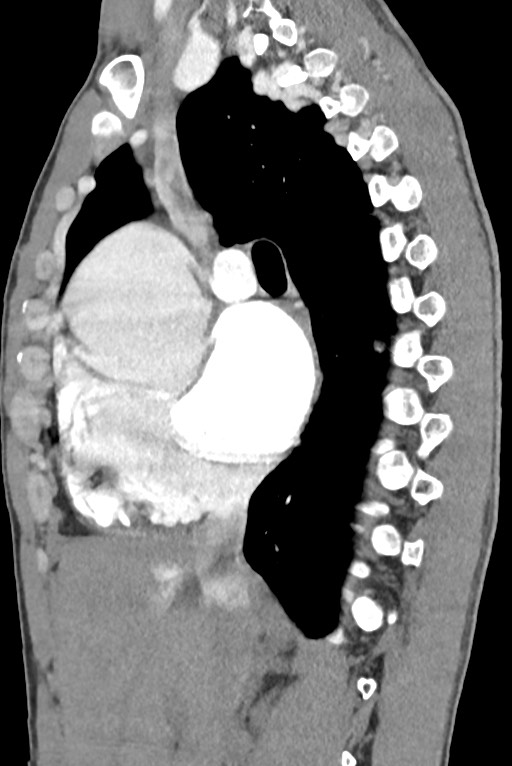 Aortic coarctation with aneurysm (Radiopaedia 74818-85828 B 69).jpg