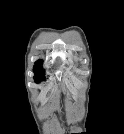 Aortic coarctation with aneurysm (Radiopaedia 74818-85828 C 12).jpg