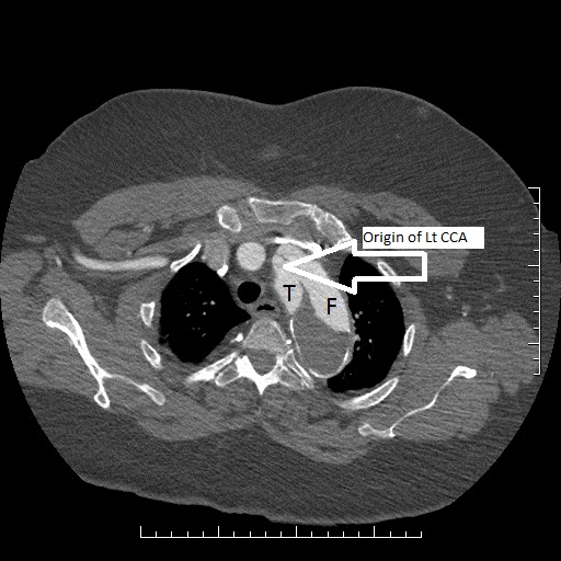 File:Aortic dissection- Stanford A (Radiopaedia 35729-39076 Multiple Annotated 2).jpg
