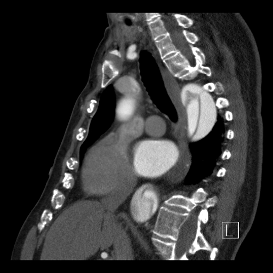 File:Aortic dissection (CTPA) (Radiopaedia 75506-86750 C 52).jpg