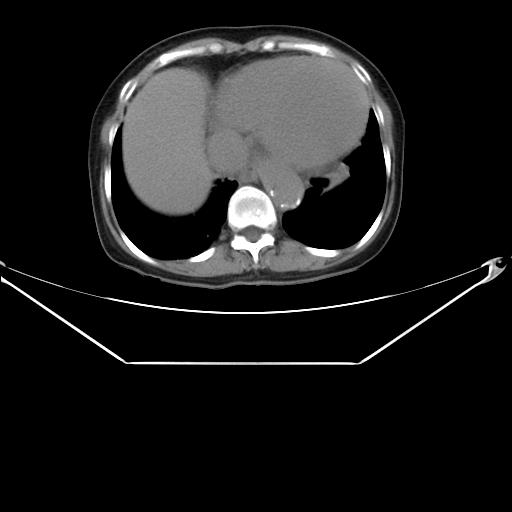 File:Aortic dissection (Radiopaedia 25350-25604 B 35).jpg