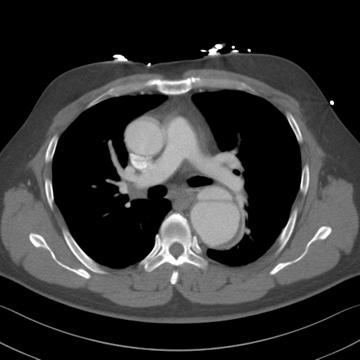Aortic dissection (Radiopaedia 50763-56234 A 26).png