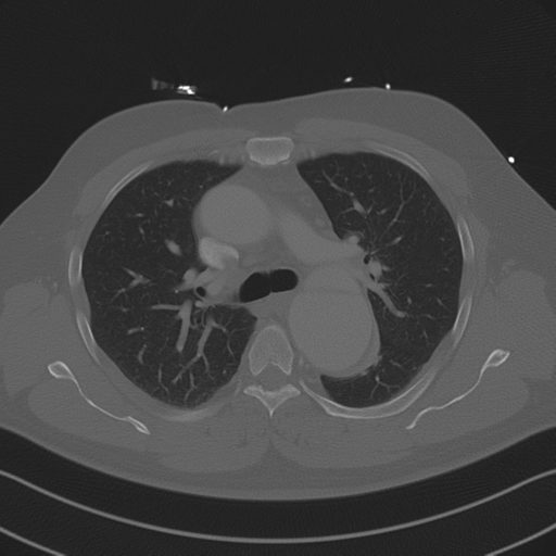 Aortic dissection (Radiopaedia 50763-56234 Axial bone window 43).png
