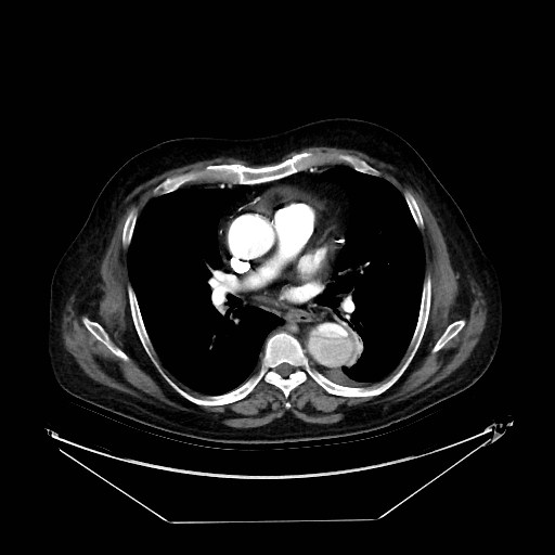 Aortic dissection (Radiopaedia 62562-71000 A 19).jpg