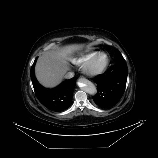 Aortic dissection (Radiopaedia 62562-71000 A 36).jpg
