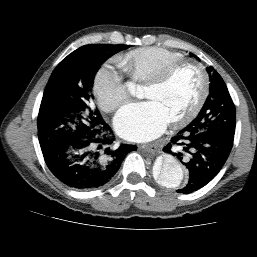 File:Aortic dissection - Stanford A -DeBakey I (Radiopaedia 28339-28587 B 59).jpg