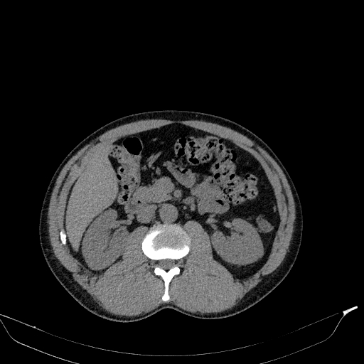 Aortic dissection - Stanford type A (Radiopaedia 83418-98500 Axial non-contrast 53).jpg