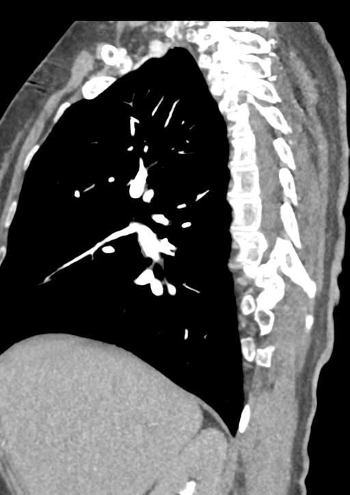 Aortic dissection - Stanford type B (Radiopaedia 50171-55512 C 47).png