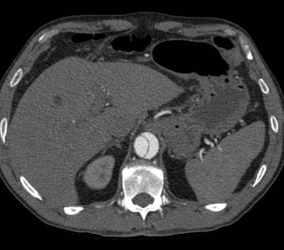 Aortic dissection - Stanford type B (Radiopaedia 73648-84437 A 113).jpg