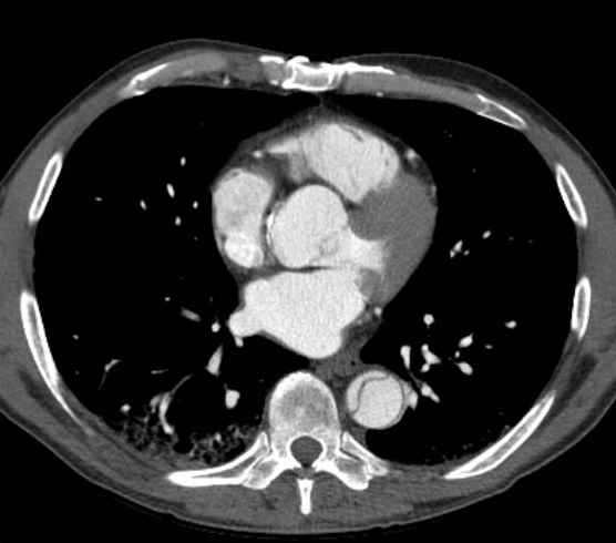 Aortic dissection - Stanford type B (Radiopaedia 73648-84437 A 67).jpg
