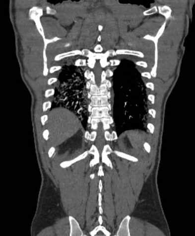 File:Aortic dissection - Stanford type B (Radiopaedia 73648-84437 B 100).jpg