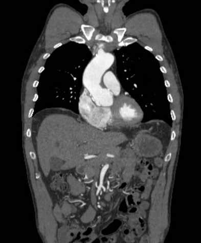 File:Aortic dissection - Stanford type B (Radiopaedia 73648-84437 B 42).jpg