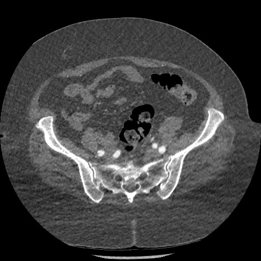 File:Aortic dissection - Stanford type B (Radiopaedia 88281-104910 A 142).jpg