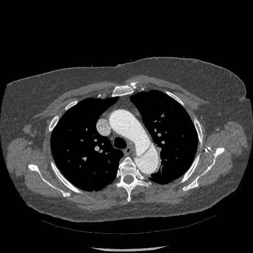 File:Aortic dissection - Stanford type B (Radiopaedia 88281-104910 A 20).jpg