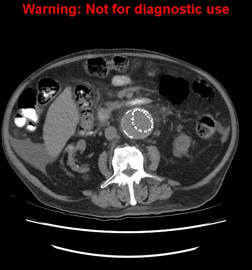 File:Aortic graft infection (Radiopaedia 44979-48907 Axial non-contrast 49).jpg
