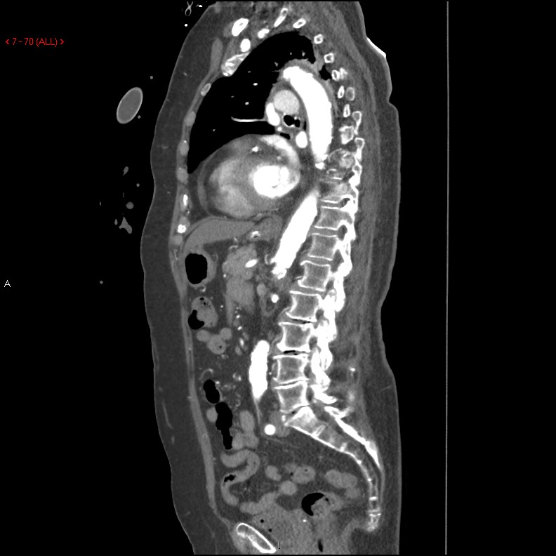 Aortic intramural hematoma (Radiopaedia 27746-28001 C 39).jpg
