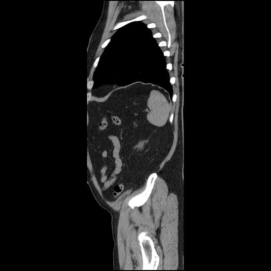 Aortic intramural hematoma (type B) (Radiopaedia 79323-92387 G 48).jpg