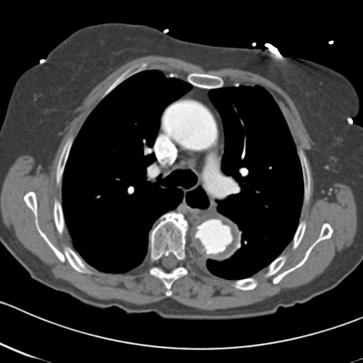 Aortic intramural hematoma from penetrating atherosclerotic ulcer (Radiopaedia 31137-31836 A 30).jpg