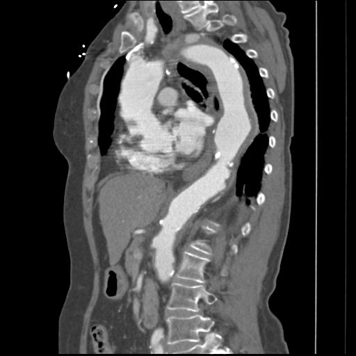 File:Aortic intramural hematoma from penetrating atherosclerotic ulcer (Radiopaedia 31137-31836 B 18).jpg