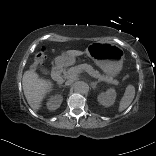 Aortic intramural hematoma with dissection and intramural blood pool (Radiopaedia 77373-89491 Axial non-contrast 103).jpg