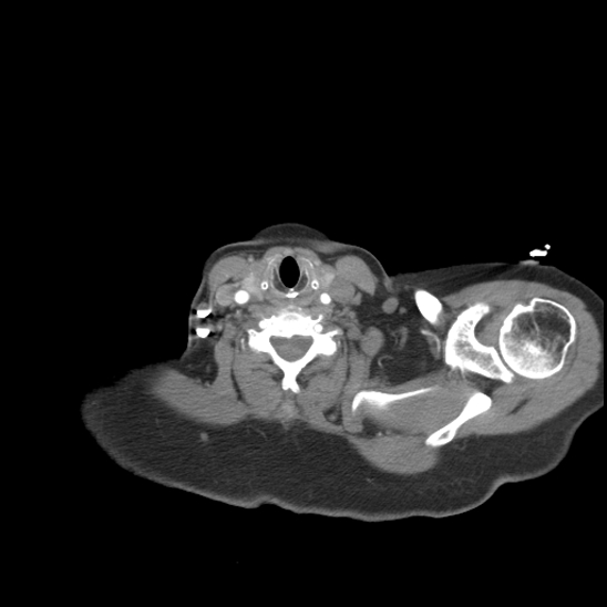 Aortic intramural hematoma with dissection and intramural blood pool (Radiopaedia 77373-89491 B 15).jpg