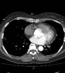 Aortic valve endocarditis (Radiopaedia 87209-103485 C 59).jpg
