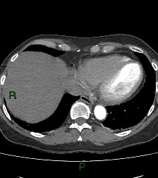 Aortic valve endocarditis (Radiopaedia 87209-103485 C 74).jpg