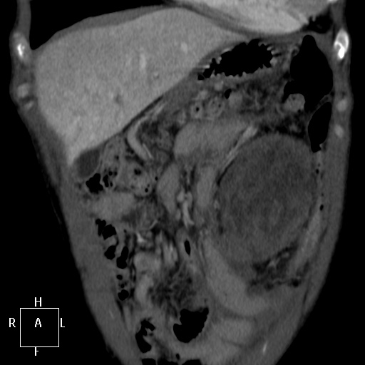 Aorto-left renal vein fistula (Radiopaedia 45534-49628 B 1).jpg