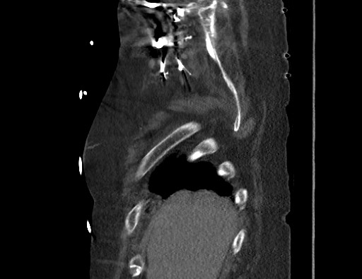 File:Aortoesophageal fistula with endovascular repair (Radiopaedia 73781-84592 Sagittal C+ CTPA 10).jpg