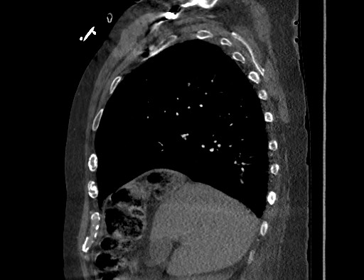 Aortoesophageal fistula with endovascular repair (Radiopaedia 73781-84592 Sagittal C+ CTPA 53).jpg