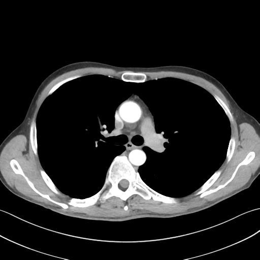 Apical pleural calcification (Radiopaedia 46141-50499 Axial C+ delayed 27).png