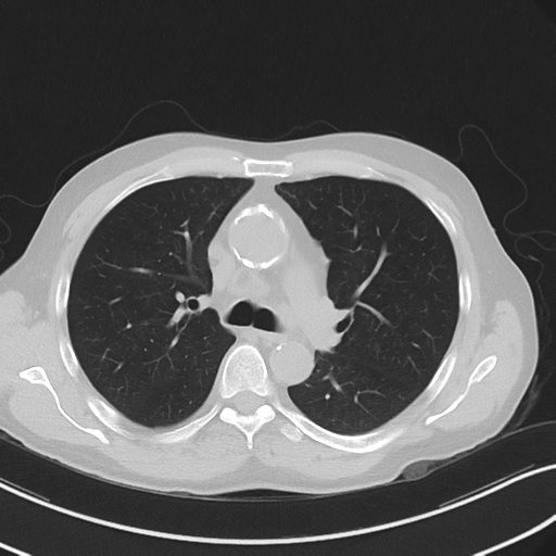 File:Apical pulmonary metastasis (Radiopaedia 46338-50754 Axial non-contrast 27).png