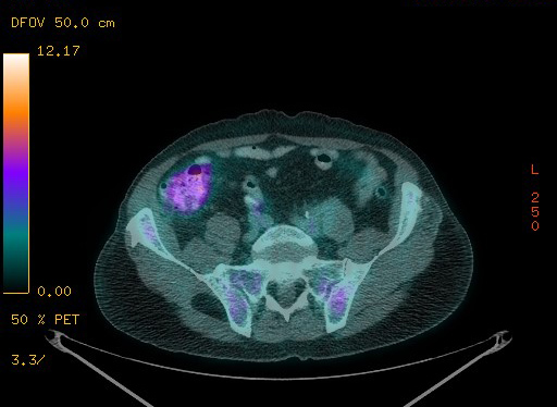 Appendiceal adenocarcinoma complicated by retroperitoneal abscess (Radiopaedia 58007-65041 Axial PET-CT 159).jpg