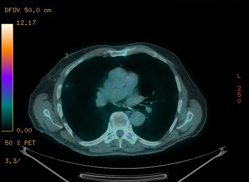 Appendiceal adenocarcinoma complicated by retroperitoneal abscess (Radiopaedia 58007-65041 Axial PET-CT 68).jpg