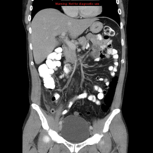 File:Appendicitis and renal cell carcinoma (Radiopaedia 17063-16760 B 13).jpg