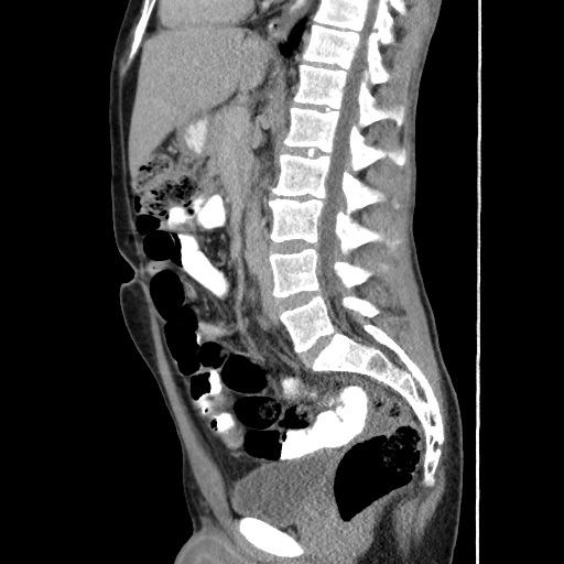 Appendicitis complicated by post-operative collection (Radiopaedia 35595-37114 C 37).jpg