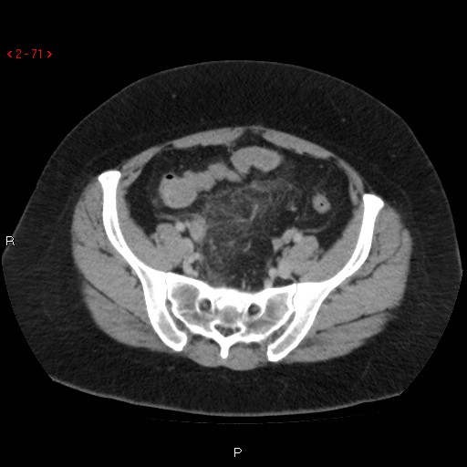 Appendicitis with microperforation- promontoric type (Radiopaedia 27268-27442 C 59).jpg