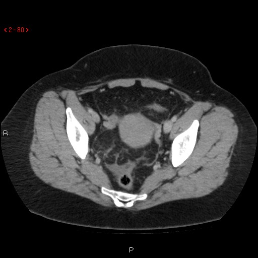 File:Appendicitis with microperforation- promontoric type (Radiopaedia 27268-27442 C 68).jpg